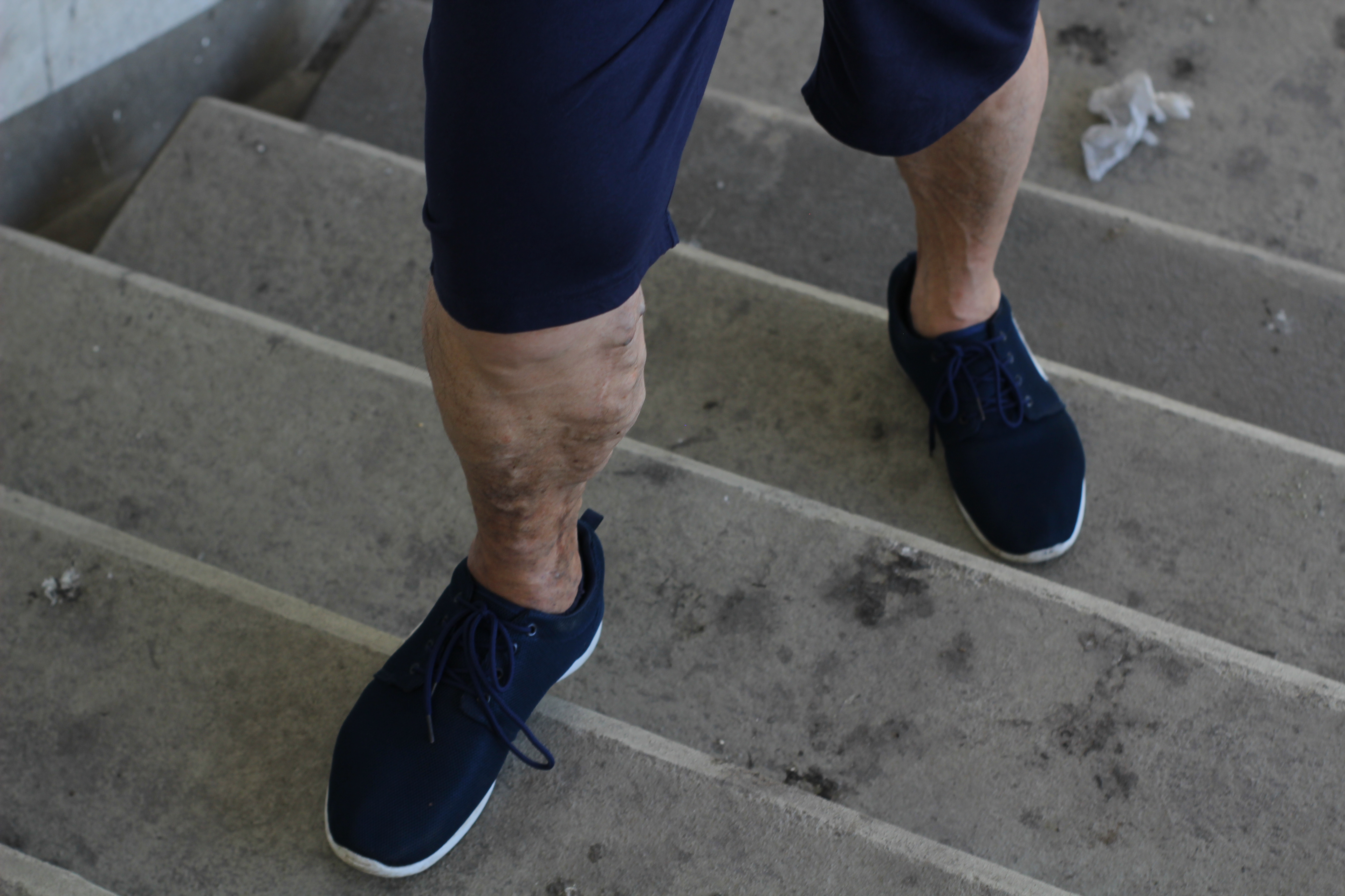 What is Chronic Venous Insufficiency?